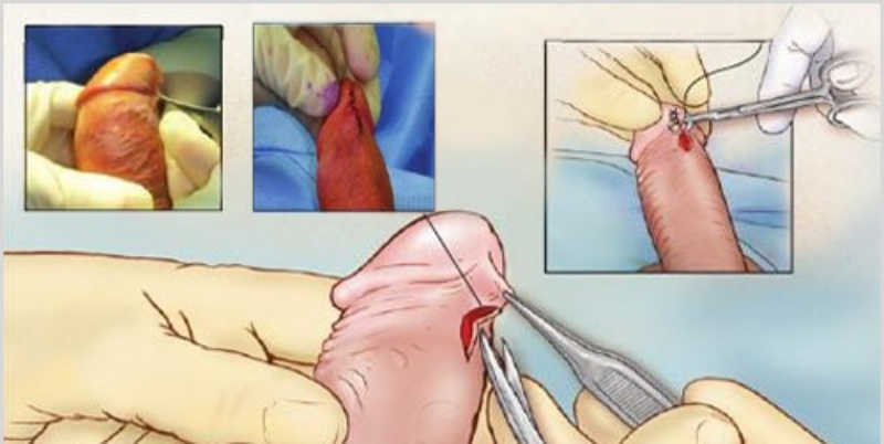 Cắt dây hãm bao quy đầu là tiểu phẫu đơn giản