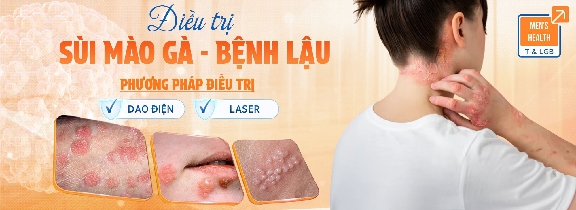 chữa sùi mào gà Quy nhơn