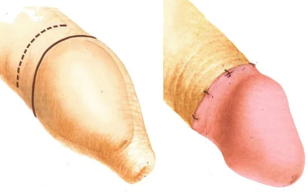 Độ tuổi cắt bao quy đầu cho con - trăn trở của nhiều bố mẹ