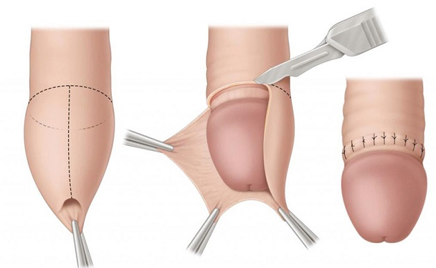 Lợi ích cắt bao quy đầu được nhiều nam giới quan tâm