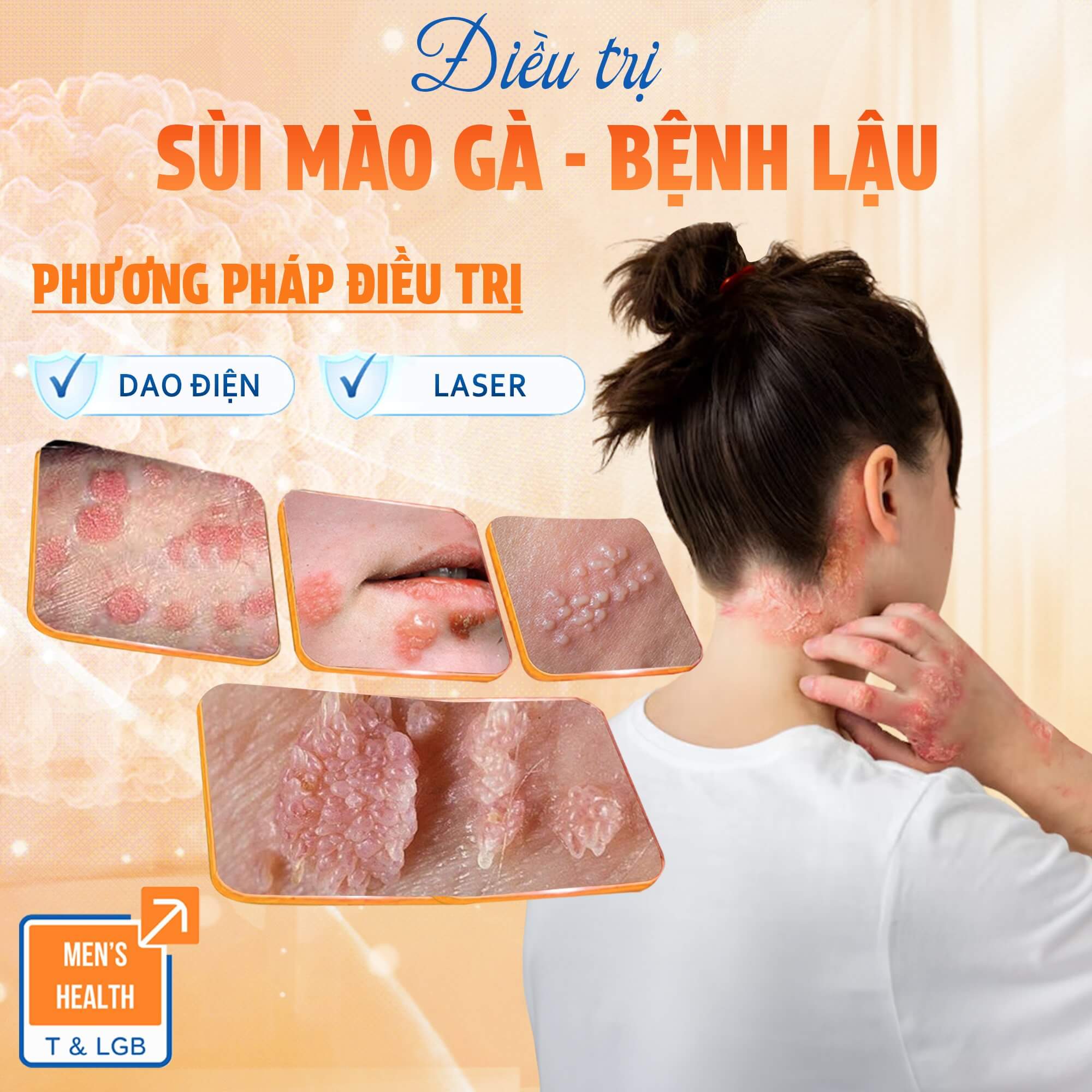 trị sùi mào gà