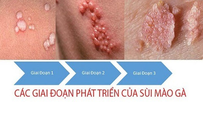 Bệnh sùi mào gà