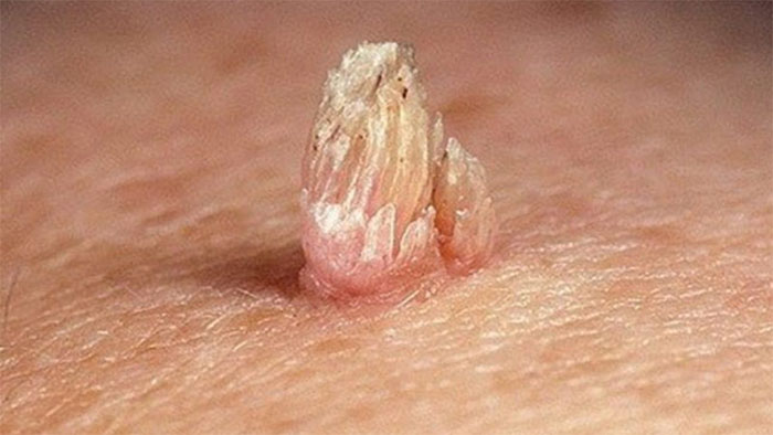 Bệnh sùi mào gà có nguy hiểm không