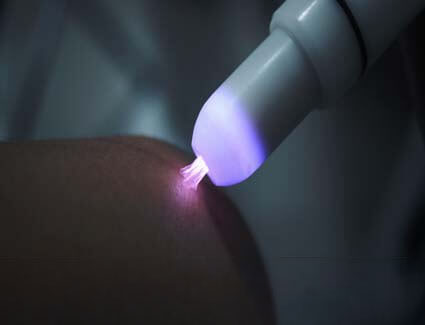Đốt sùi mào gà ở nam giới bằng laser