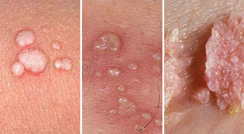 HPV virus