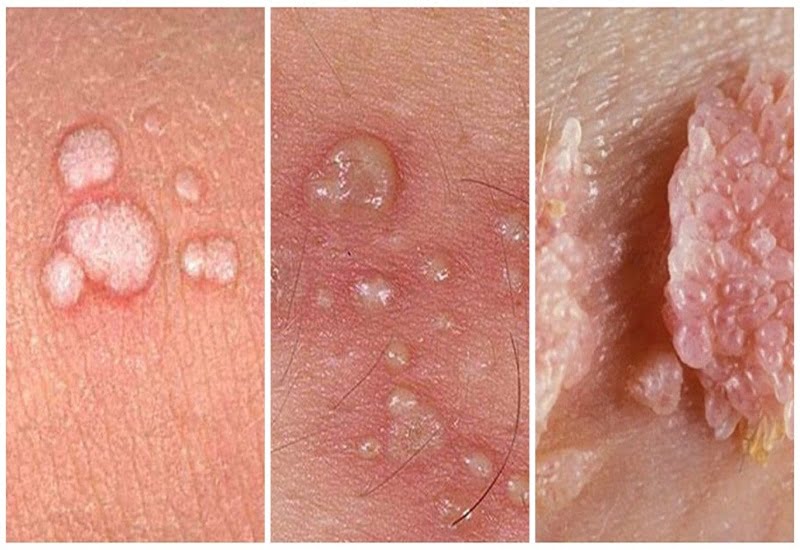 giai đoạn sùi mào gà phát triển