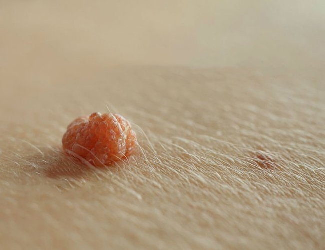 Dấu hiệu bệnh sùi mào gà