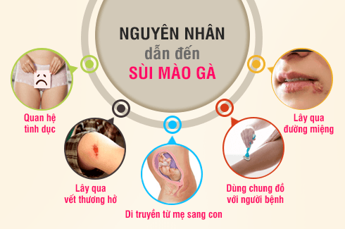 nguyên nhân lây nhiễm bệnh sùi mào gà