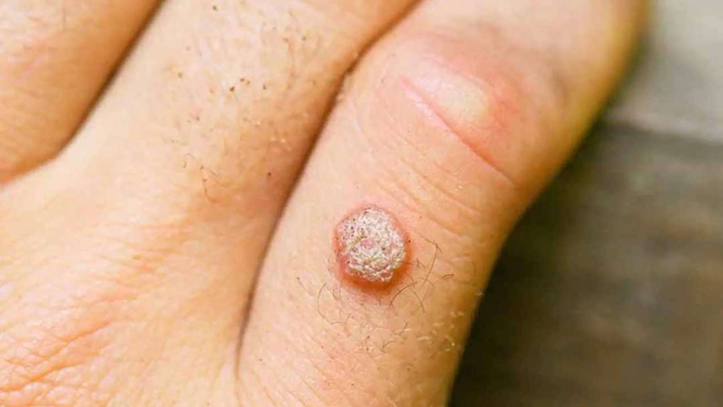 phân biệt mụn cóc và HPV