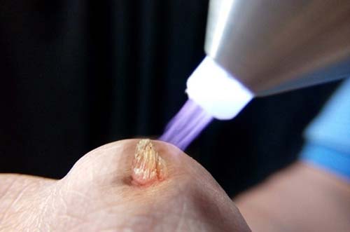 Phương pháp đốt laser