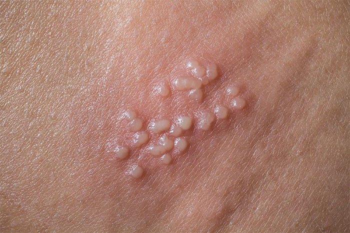 Bệnh sùi mào gà có nhiều loại Virus HPV nguy hiểm