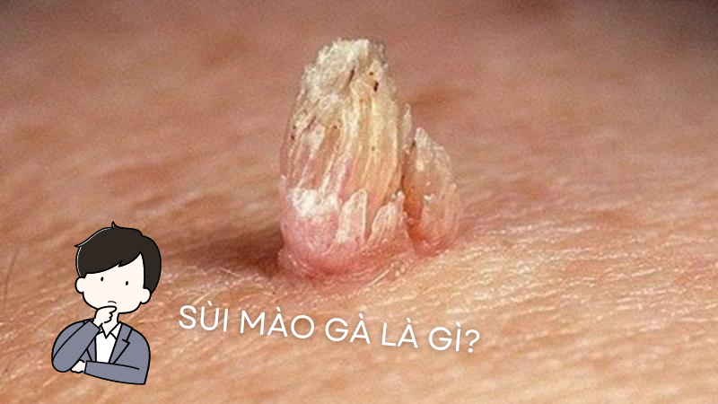 thắc mắc về sùi mào gà là gì