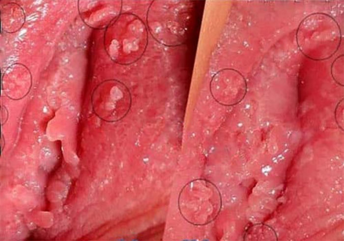 hình ảnh bệnh Sùi mào gà ở âm hộ