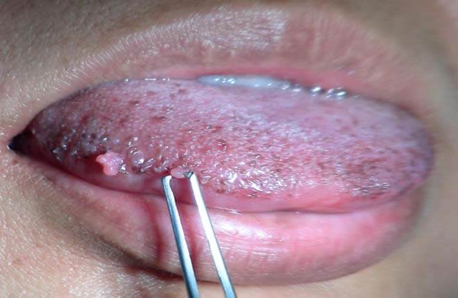 hình ảnh Sùi mào gà ở lưỡi