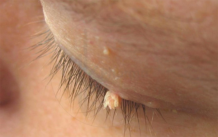 sùi mào gà ở mắt