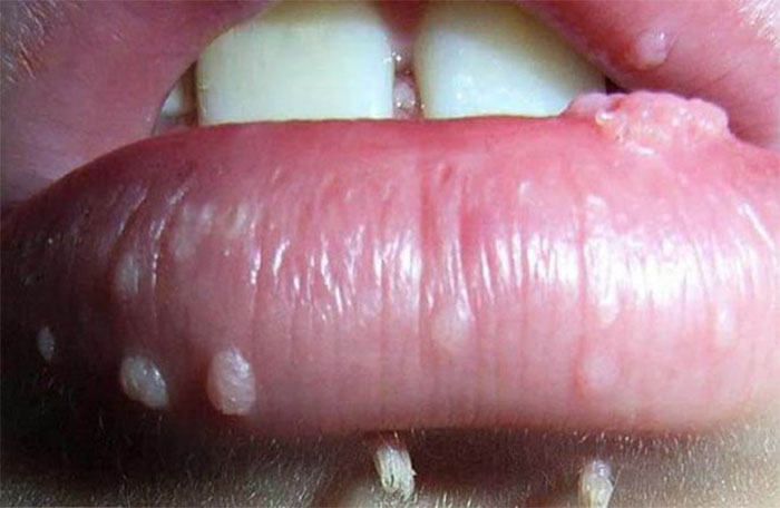 Sùi mào gà ở miệng