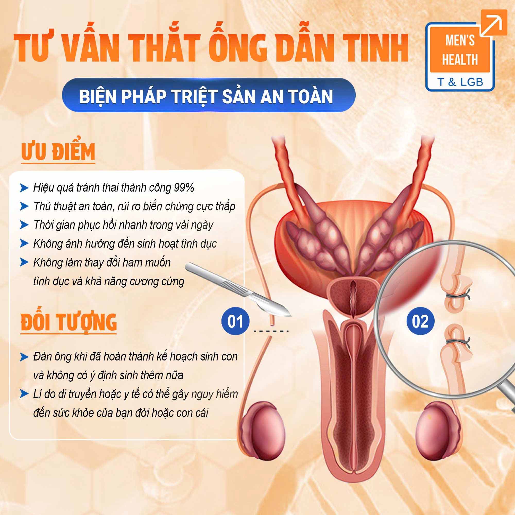 thắt ống dẫn tinh