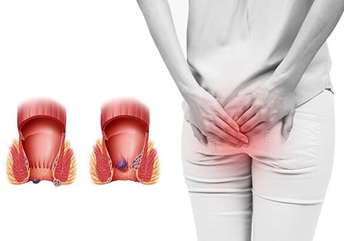 nguyên nhân bệnh sùi mào gà từ quan hệ qua hậu môn