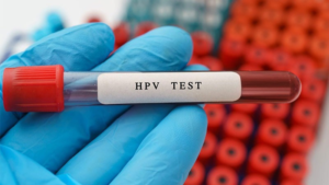 Một số phương pháp xét nghiệm HPV phổ biến