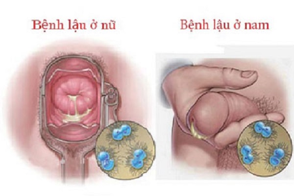 Triệu chứng bệnh lậu ở nam và nữ