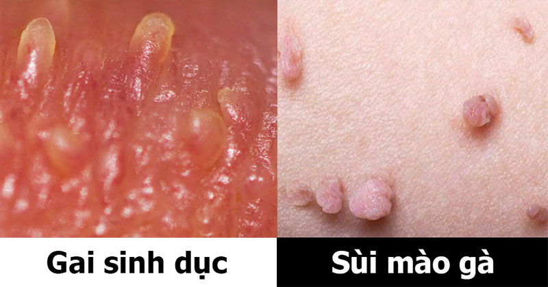 Gai sinh dục và sùi mào gà