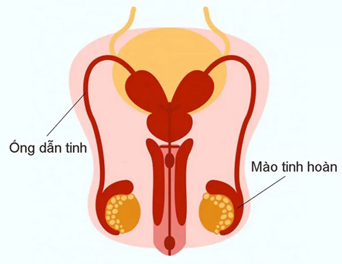 Thắt ống dẫn tinh có nối lại được không