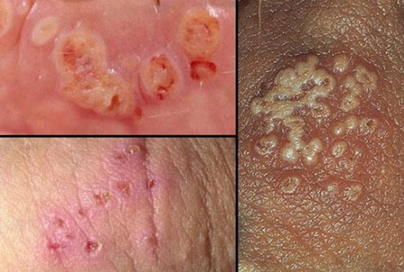 Chữa bệnh lậu Bình Định