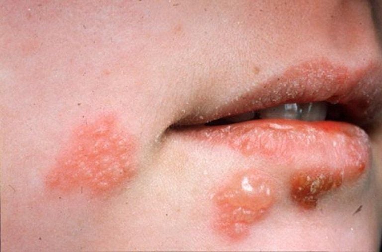 Chi phí xét nghiệm bệnh lậu