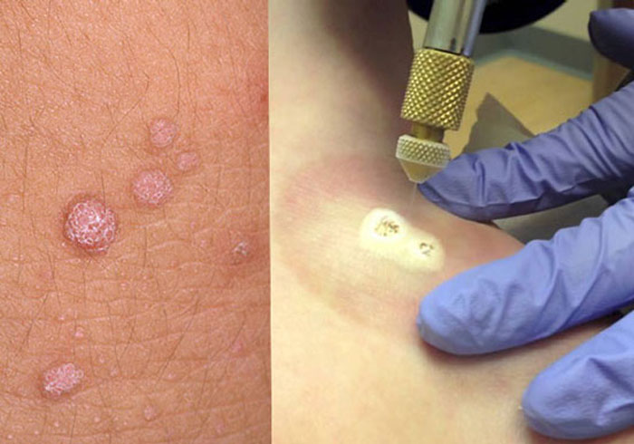 Phương pháp đốt laser
