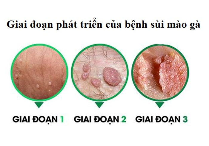 Điều trị sùi mào gà nữ Quy Nhơn Gia Lai