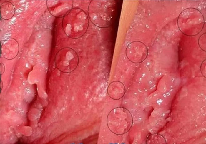 Điều trị sùi mào gà nữ Quy Nhơn Gia Lai