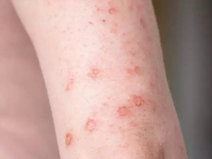Chi phí xét nghiệm bệnh xã hội