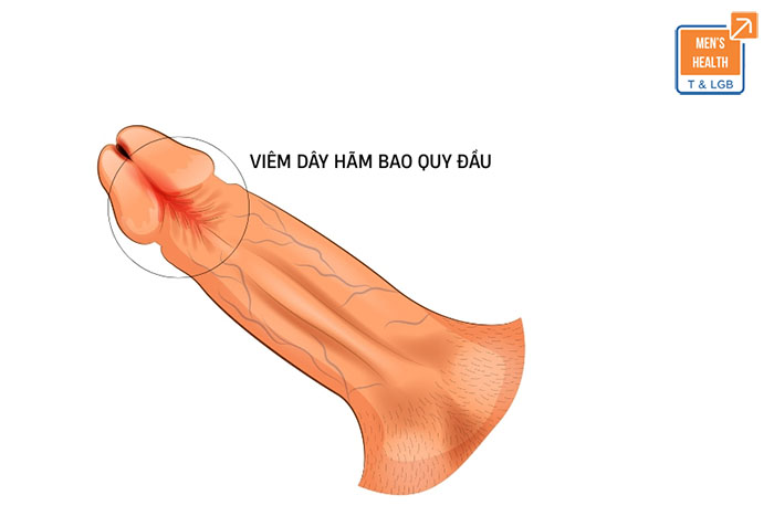 điều trị ngắn dây hãm