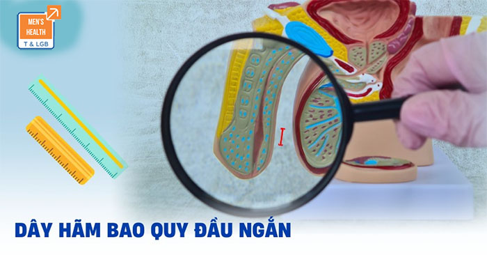 điều trị ngắn dây hãm